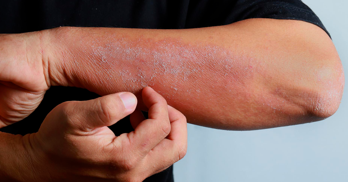 Você sabe como prevenir a dermatite na indústria?